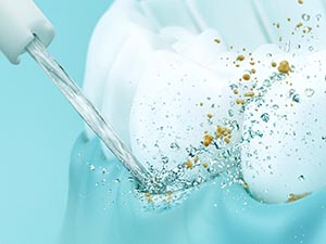 Periodontal Pocket Cleaning