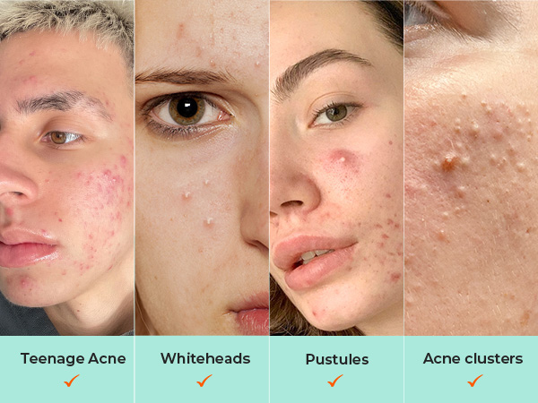 Acne patches