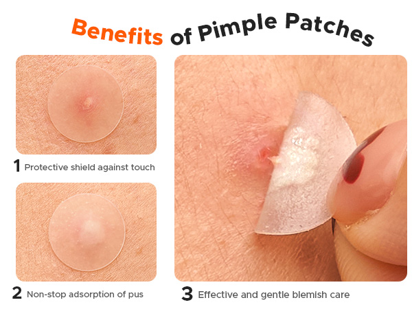 Benefits of Pimple Patches