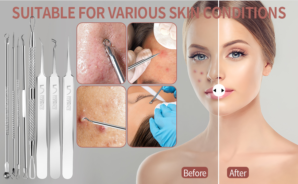 Blackhead Remover Tools