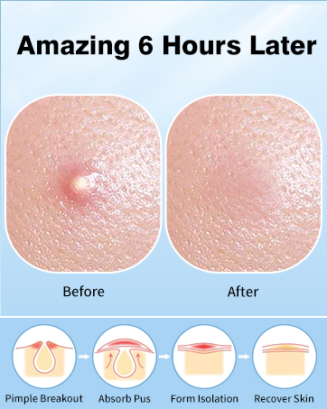 Pimple patches for face