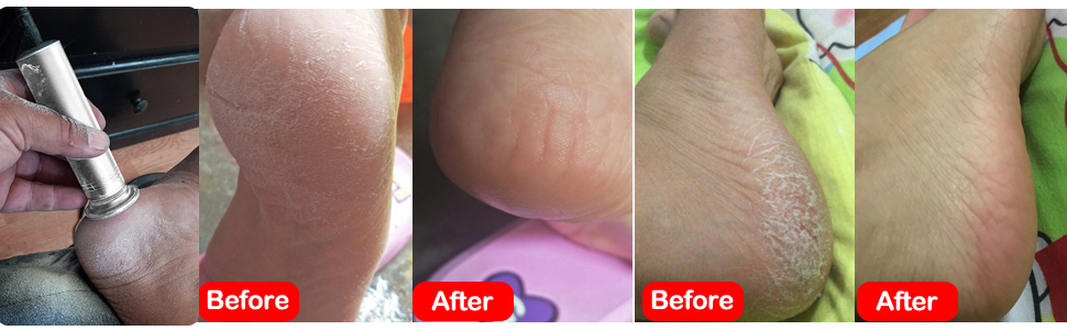 electric callus remover for feet