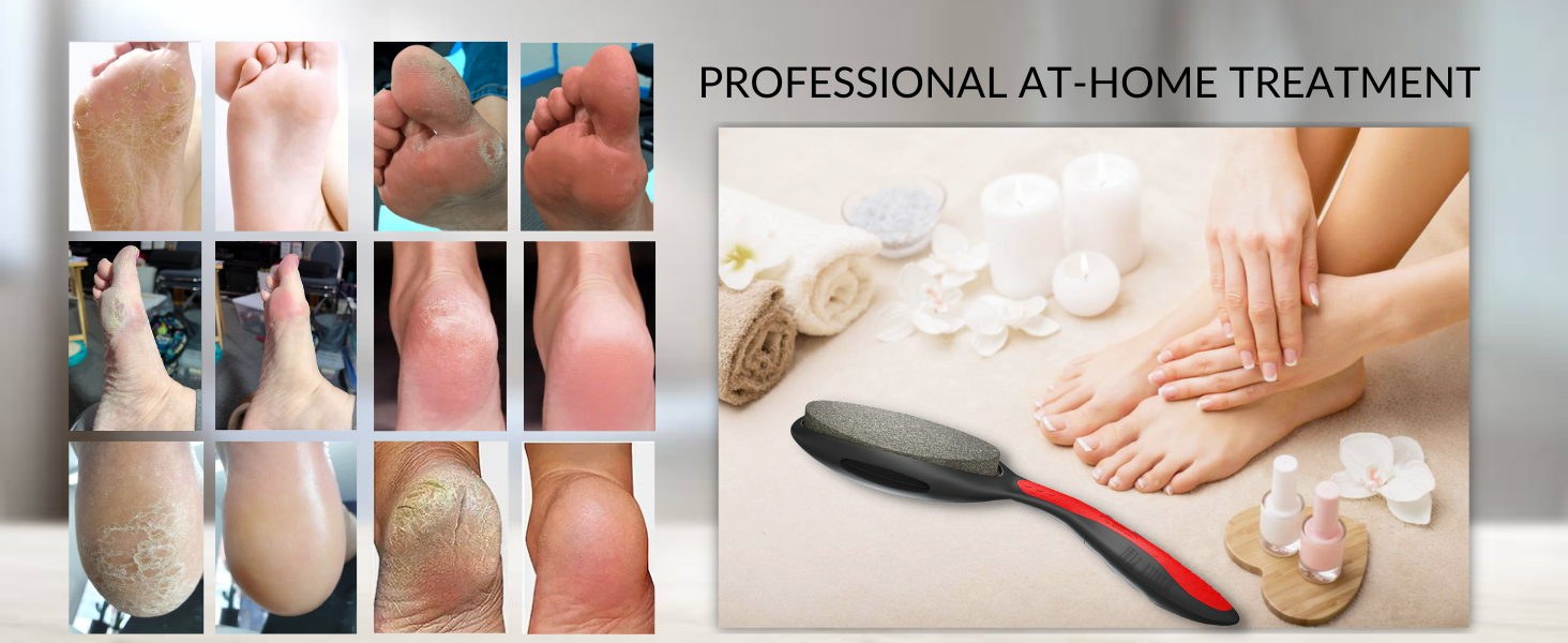 WONDER PEDI PREMIUM CALLUS REMOVER, foot file dead skin remover for feet