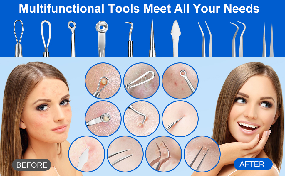 zit popper tool
