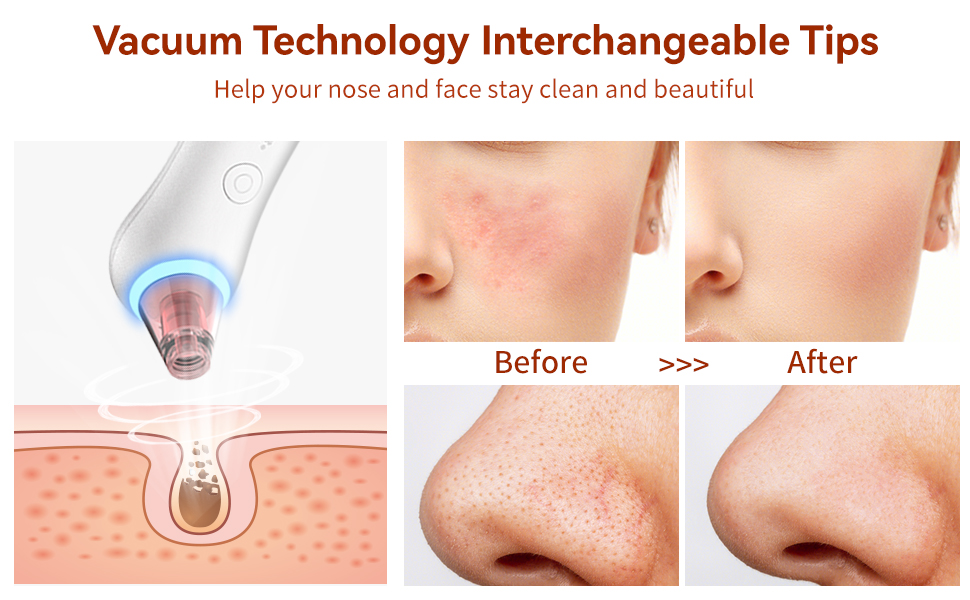 GERY blackhead remover effect comparison