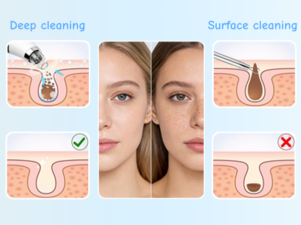 blackhead vacuum