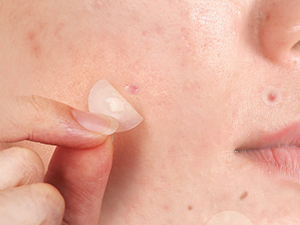 pimple patches for face
