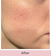 Text reads 'After'. Close-up of skin texture on neck/jawline area showing skin appearance, demonstrating product result.