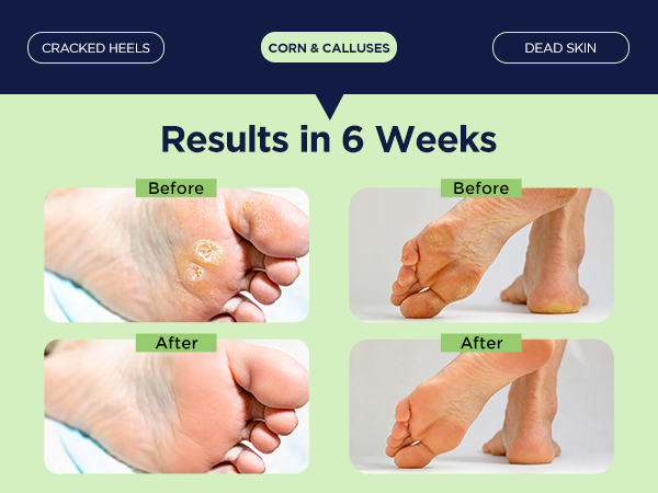 Corn & Calluses