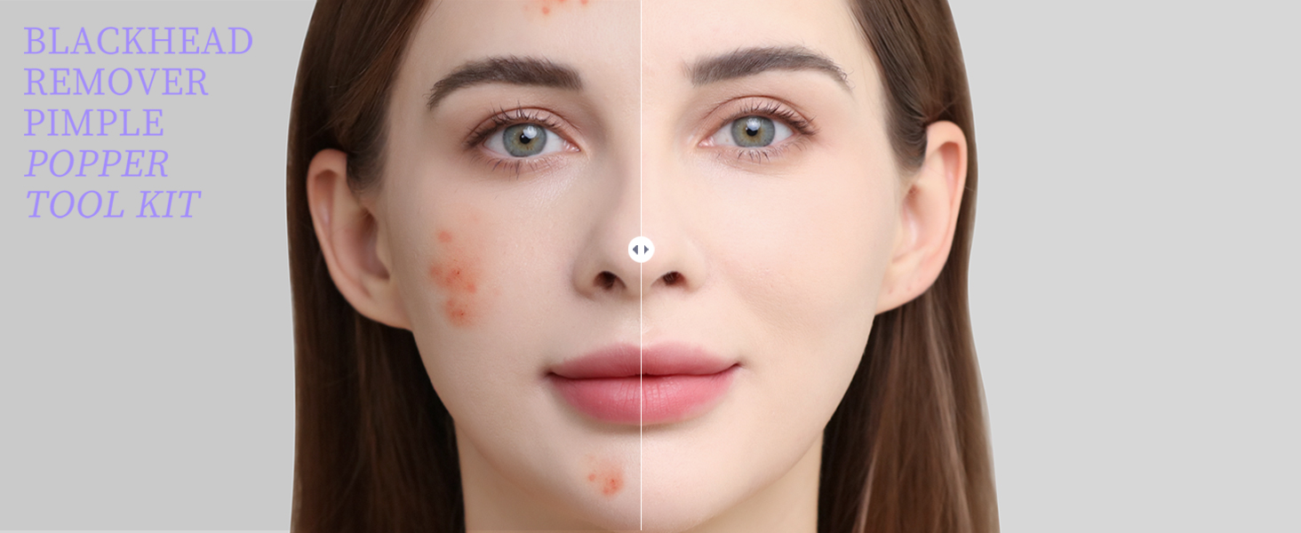 Blackhead Remover