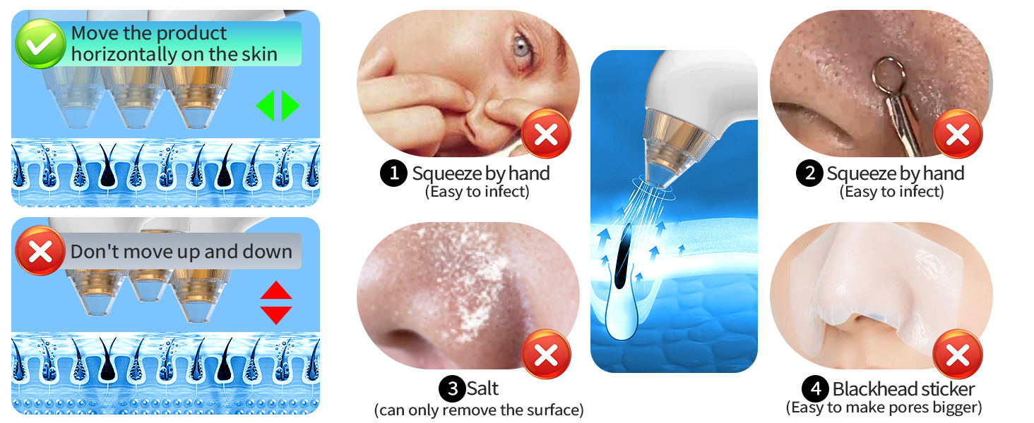 Blackhead remover