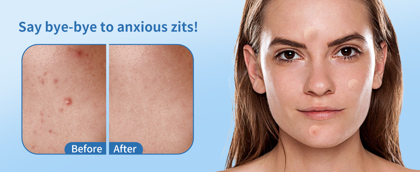 pimple patches
