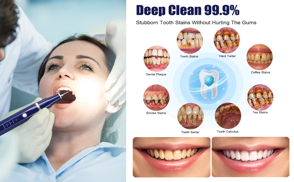 teeth stains remover