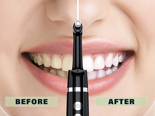 tartar remover for teeth