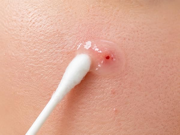 blackhead extractor