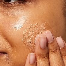 acne