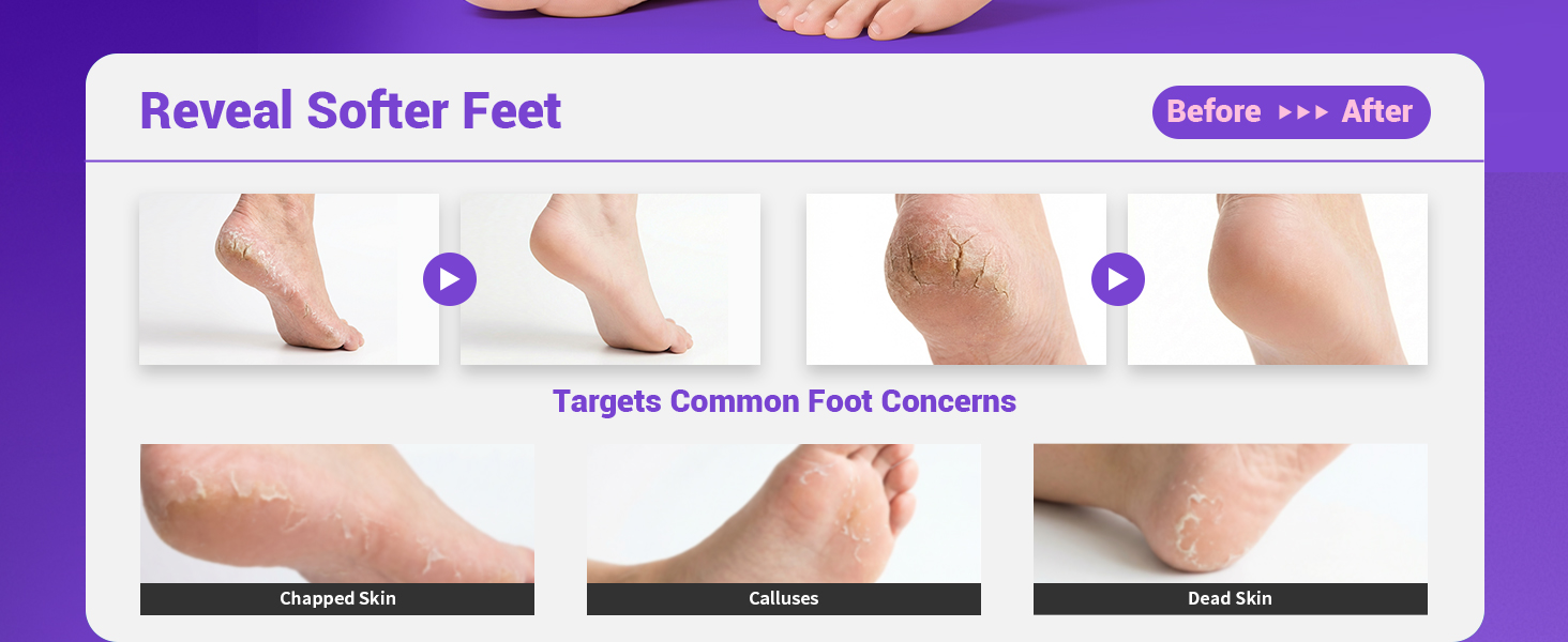 callus removers