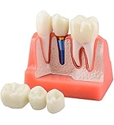 Ultrassist Dental Implant Model for Patient Education, 4 Times Dental Implant, Crown and Bridge M...