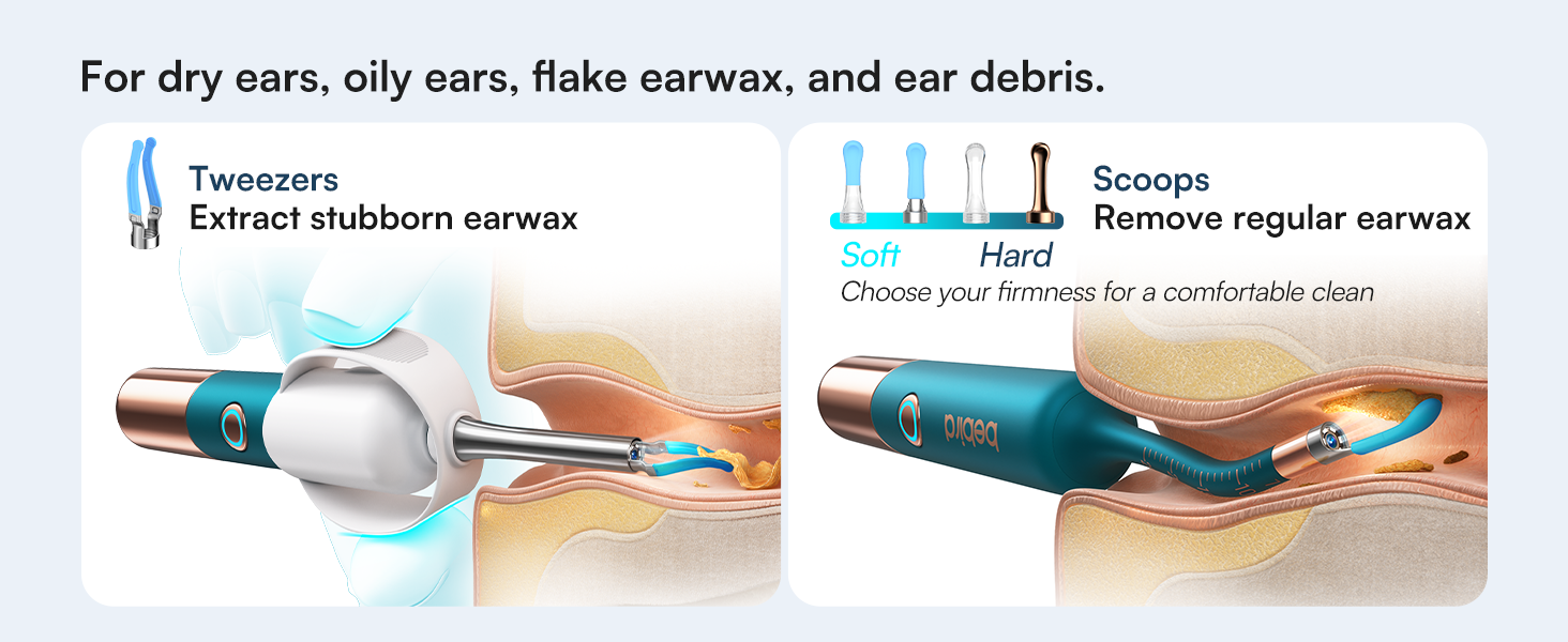 earwax removal