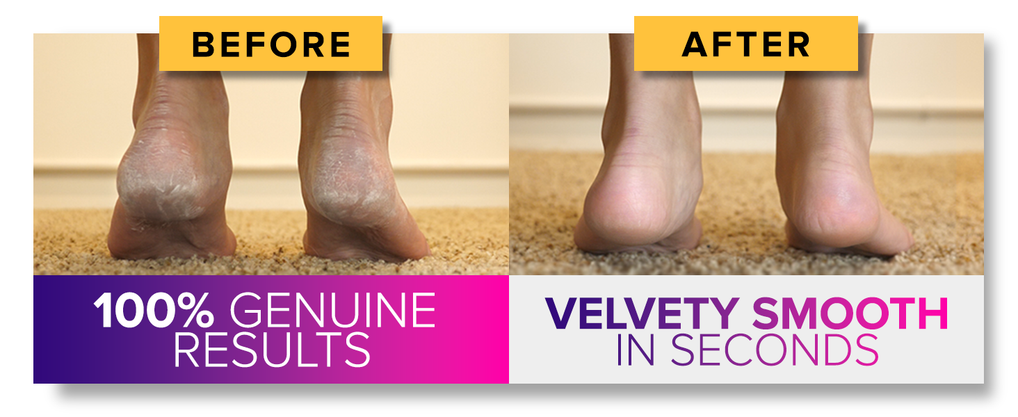 Before and after foot comparison. 'Before' shows dry, cracked heels. 'After' shows smooth feet. Claims 100% genuine results and velvety smooth in seconds.