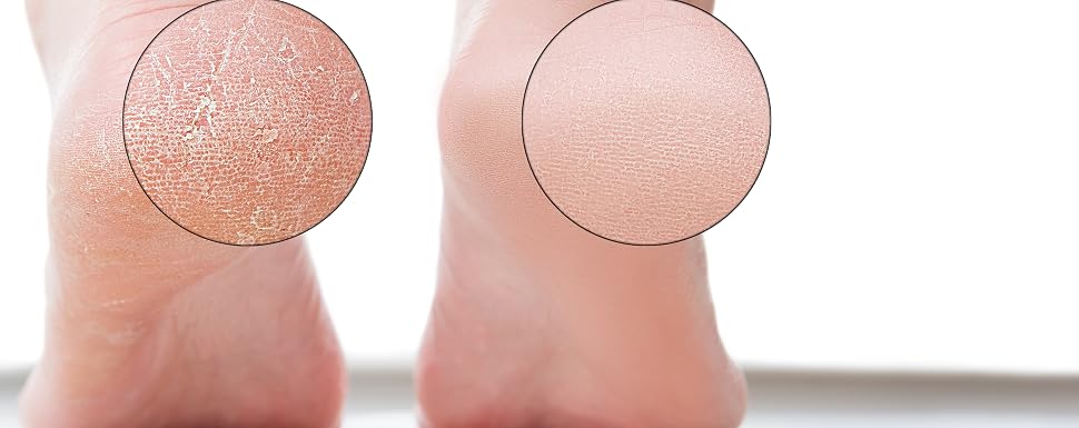 callus remover for feet