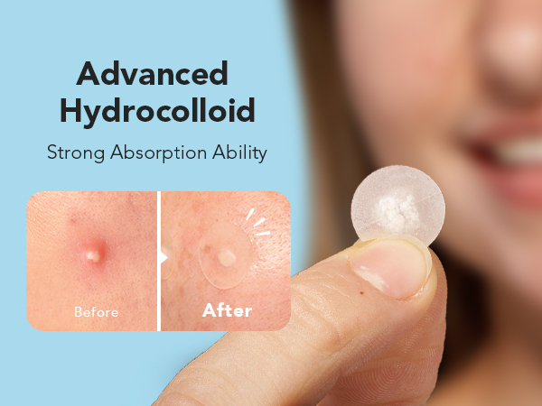 acne patches for face