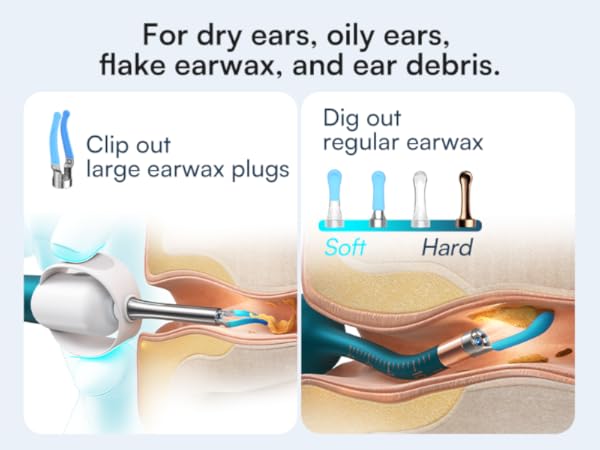 earwax removal