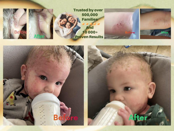 Eczema cream, rash cream, tea tree oil balm for skin