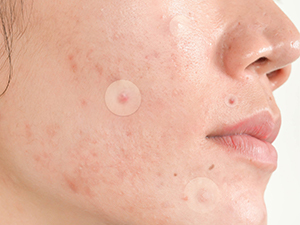 pimple patches for face