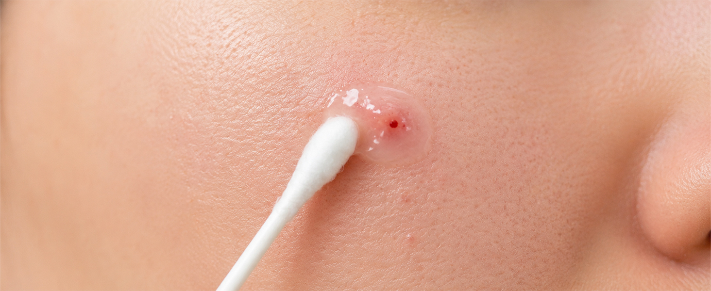 blackhead extractor