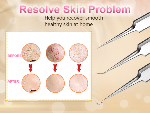Blackhead remover tweezers