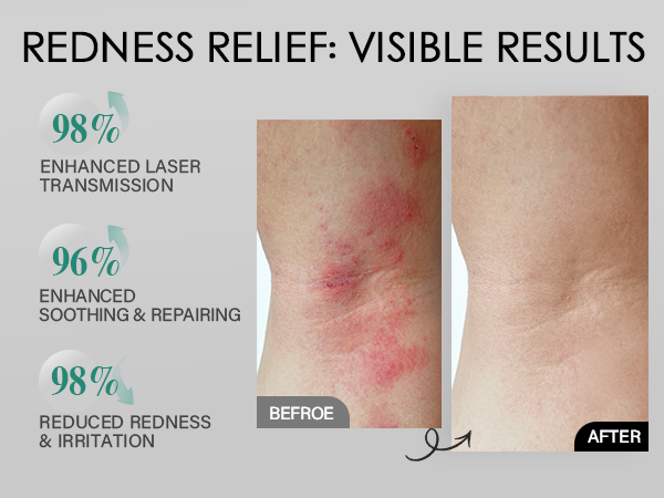 laser hair removal for women