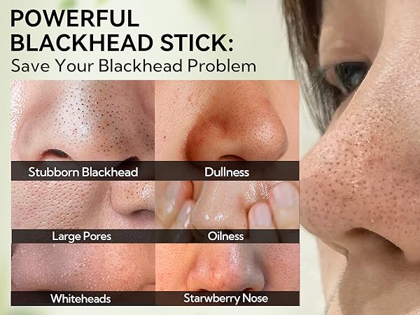 blackhead problem