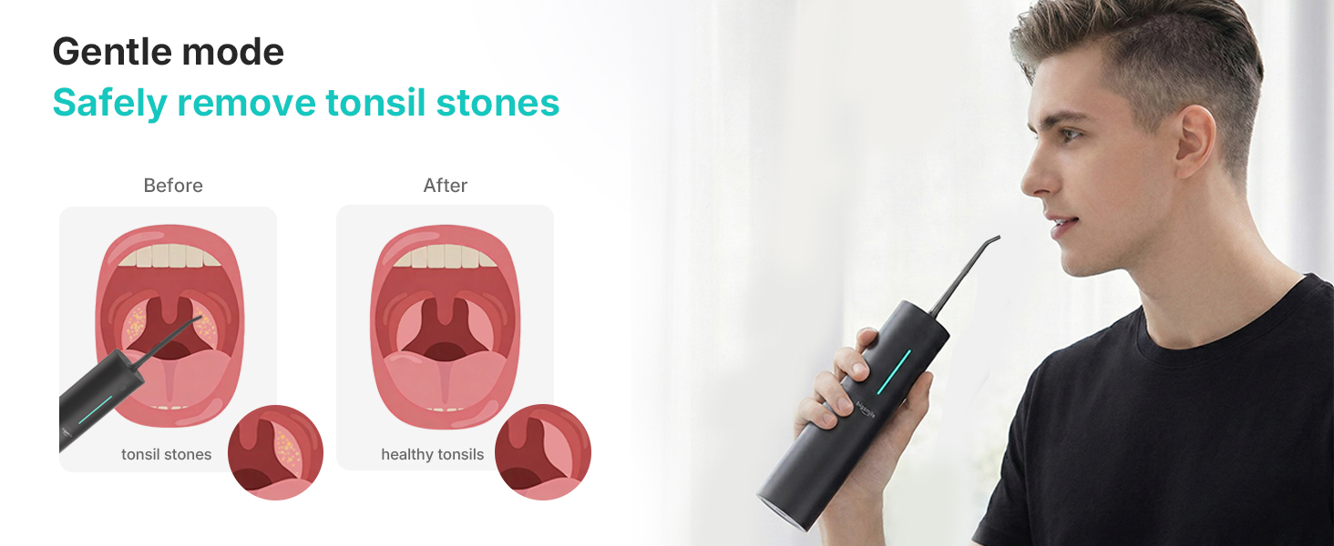 water flosser for tonsil stone