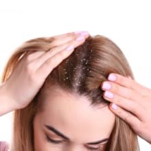 Dandruff
