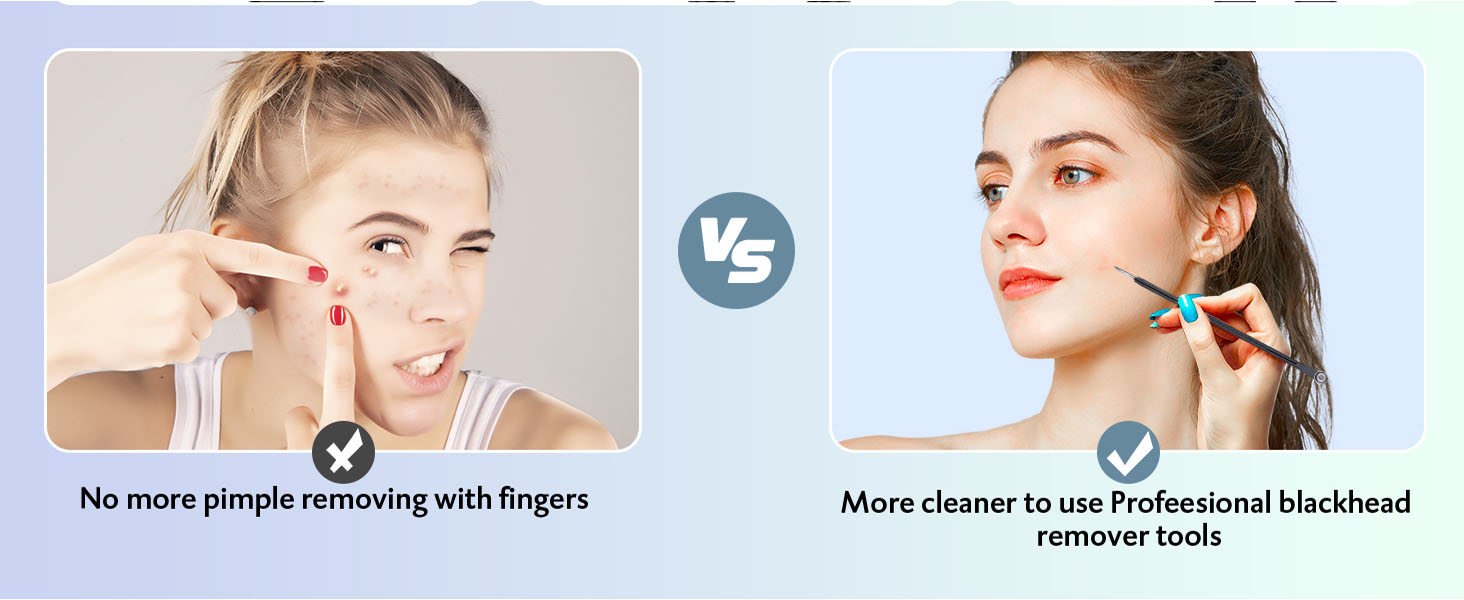 Acne Tools, Acne Kit for Blackhead,Blemish