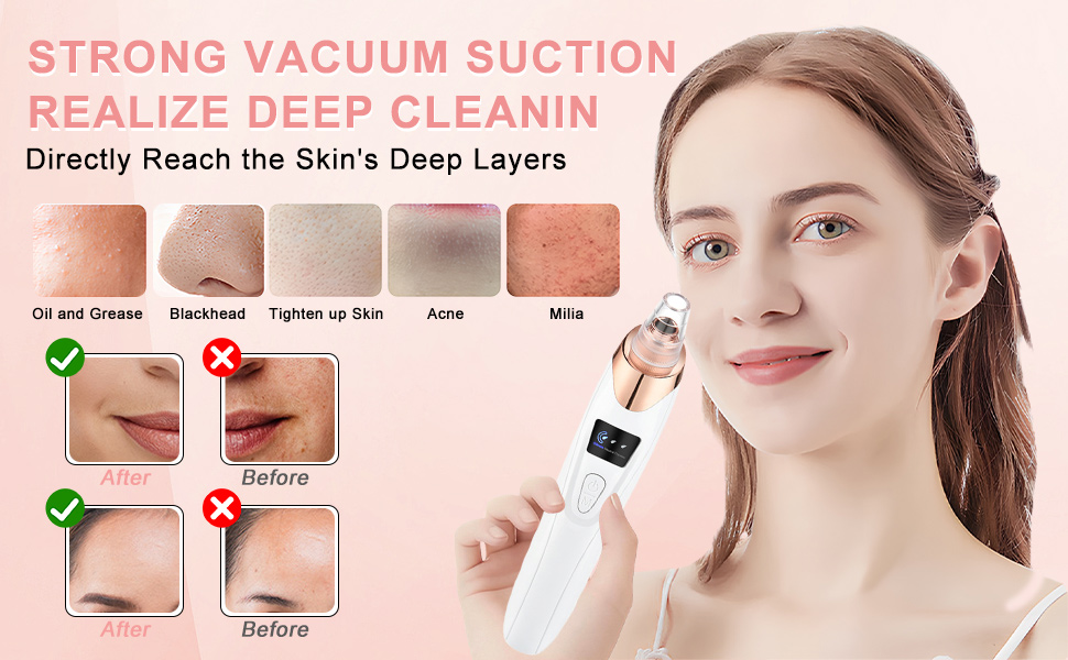 black head remover for face