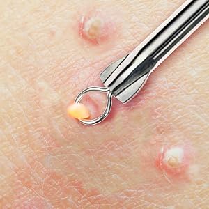 Beaute Galleria Needle Blackhead Pimple Extractor Popper for Acne Comedone Blemish Removal Tool