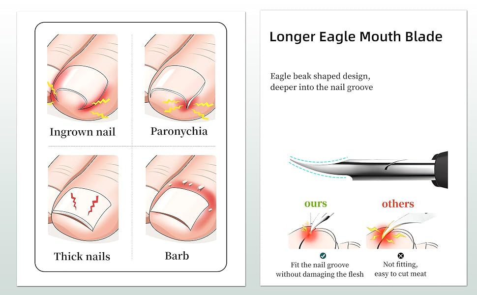 ingrown toenail removal kit nail cutter ingrown toenail treatment nail clippers for women