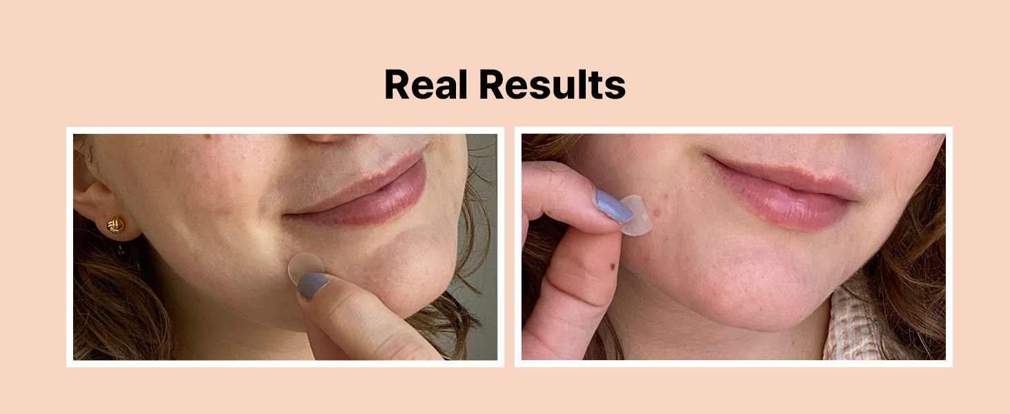 real results suck gunk out pimples whiteheads fast healing adhesive leave on overnight reduce size