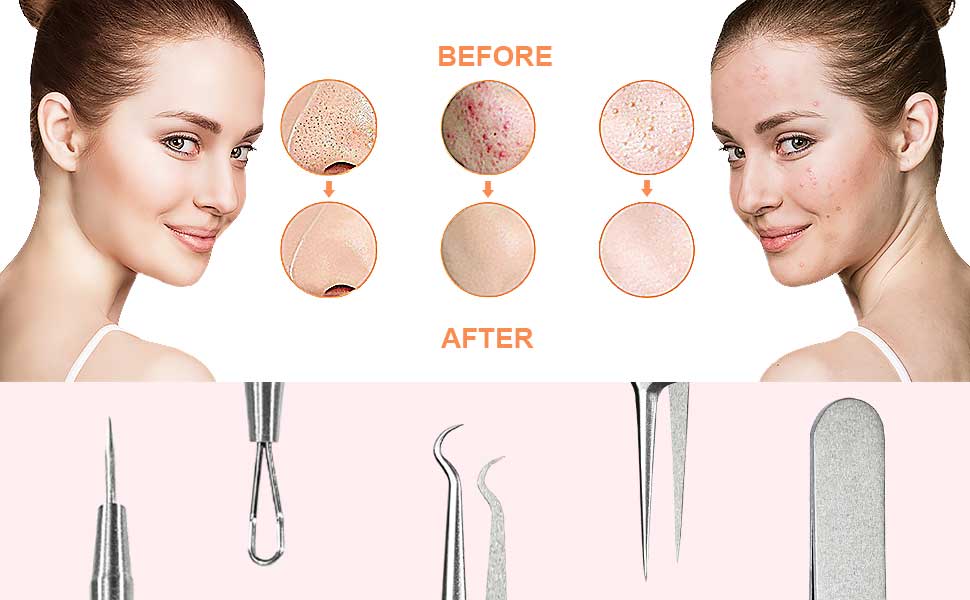 blackhead extractor