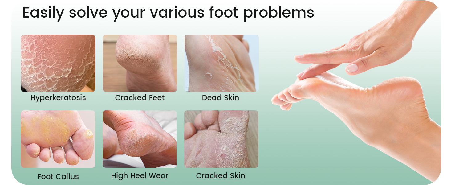 foot callus remover pedicure foot spa foot care feet scrubber dead skin foot scrub heel scraper foot