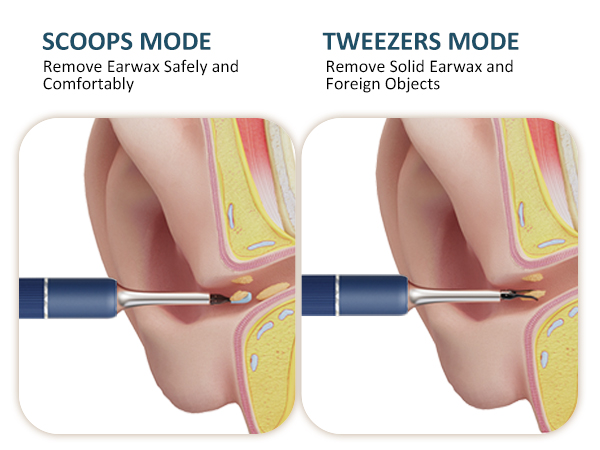 ear wax removal camera