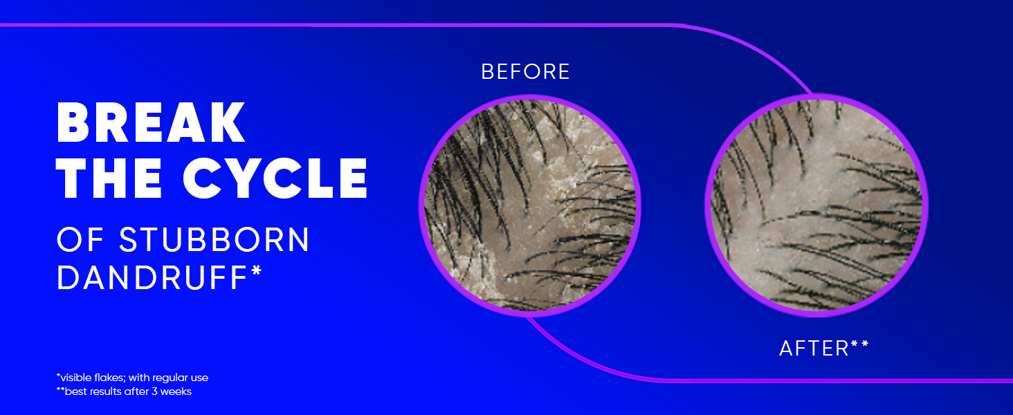 Break the cycle of stubborn dandruff for visible flakes relief with regular use.