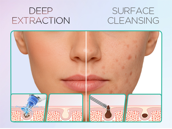 blackhead remover