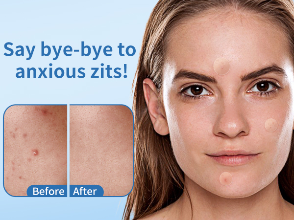 pimple patches