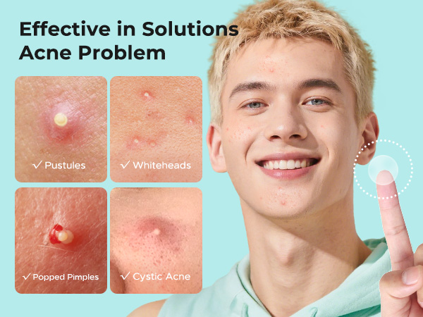 pimple patches