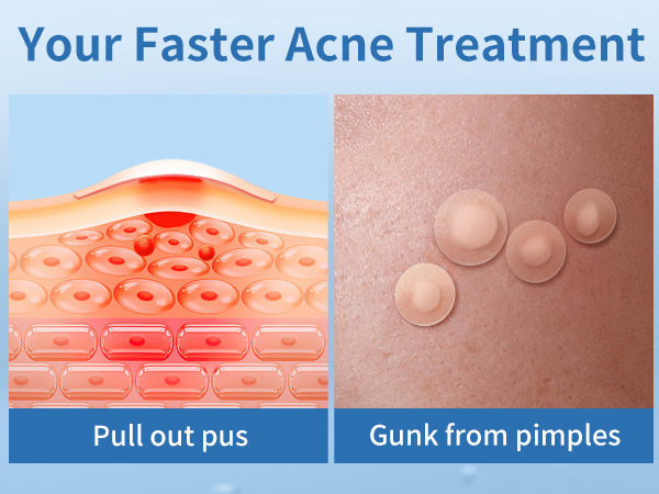 pimple patches for face