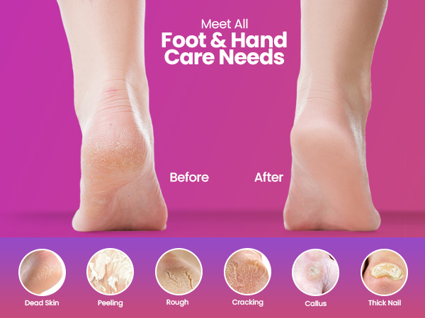 electric foot file