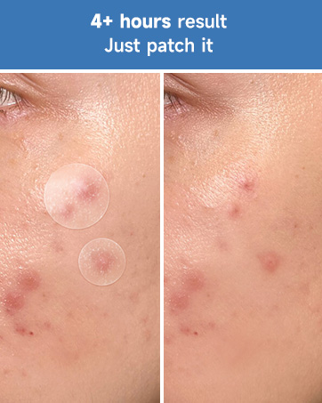pimple patches